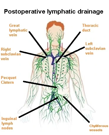 Postoperative lymphatic drainage