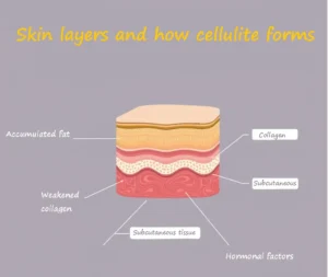 What causes cellulite